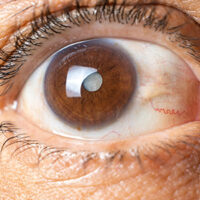 Inf-Cataratas Inf-Cataratas