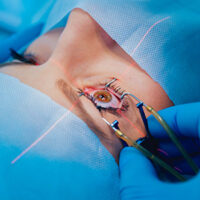 Inf-Defectos-refractivos Inf-Defectos-refractivos