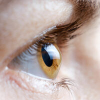 Inf-Queratocono Inf-Queratocono