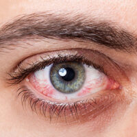 Inf-Resequedad-en-tus-ojos Inf-Resequedad-en-tus-ojos